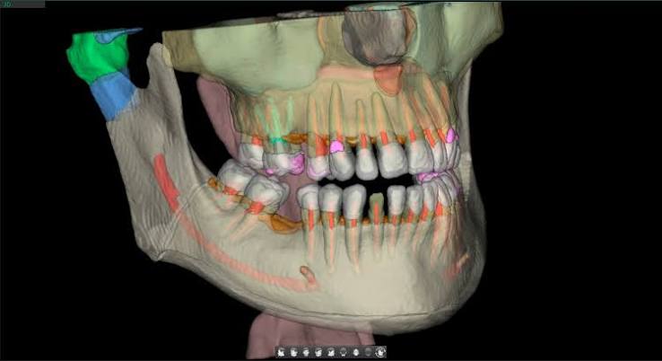 Reconstrucción tridimensional de un maxilar obtenida con el escáner CBCT