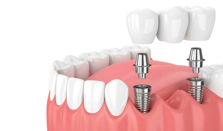 Implantes dentales de titanio