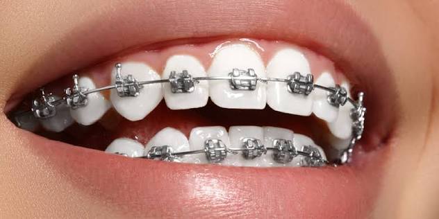 Sonrisa con ortodoncia fija