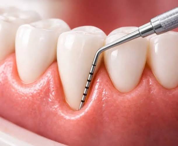 Sondaje periodontal midiendo la encía alrededor de un diente