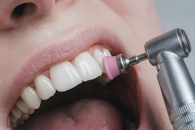 Pulido dental con copa de goma durante una limpieza