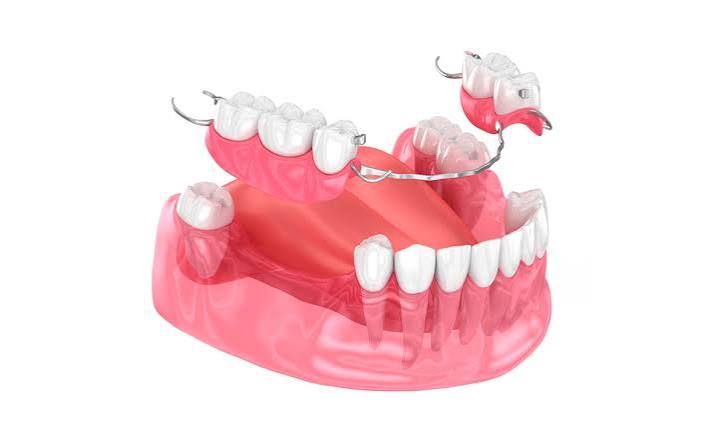 Prótesis dental removible parcial sobre la encía